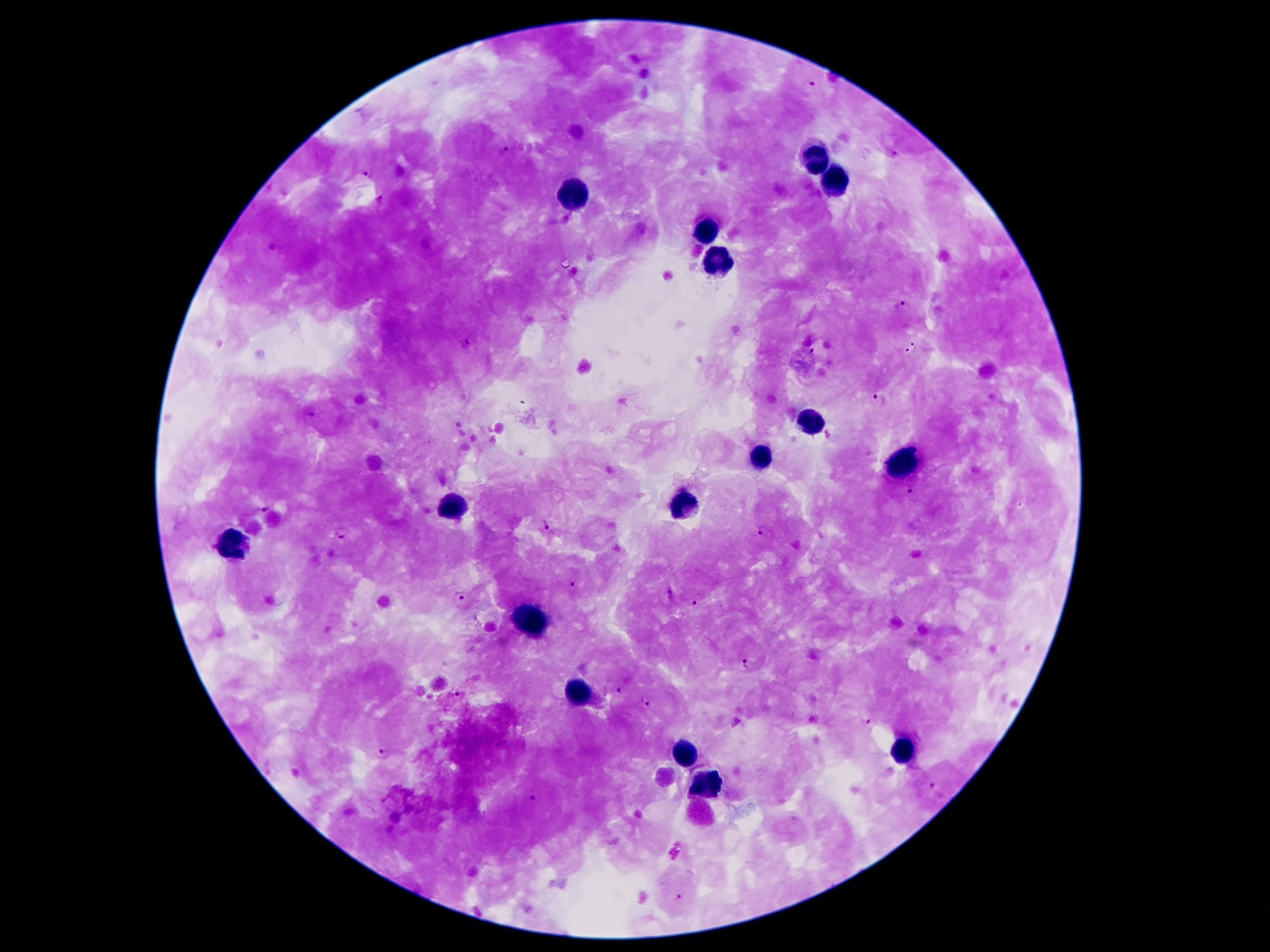 What Is The Difference Between Thick And Thin Blood Smear For Malaria