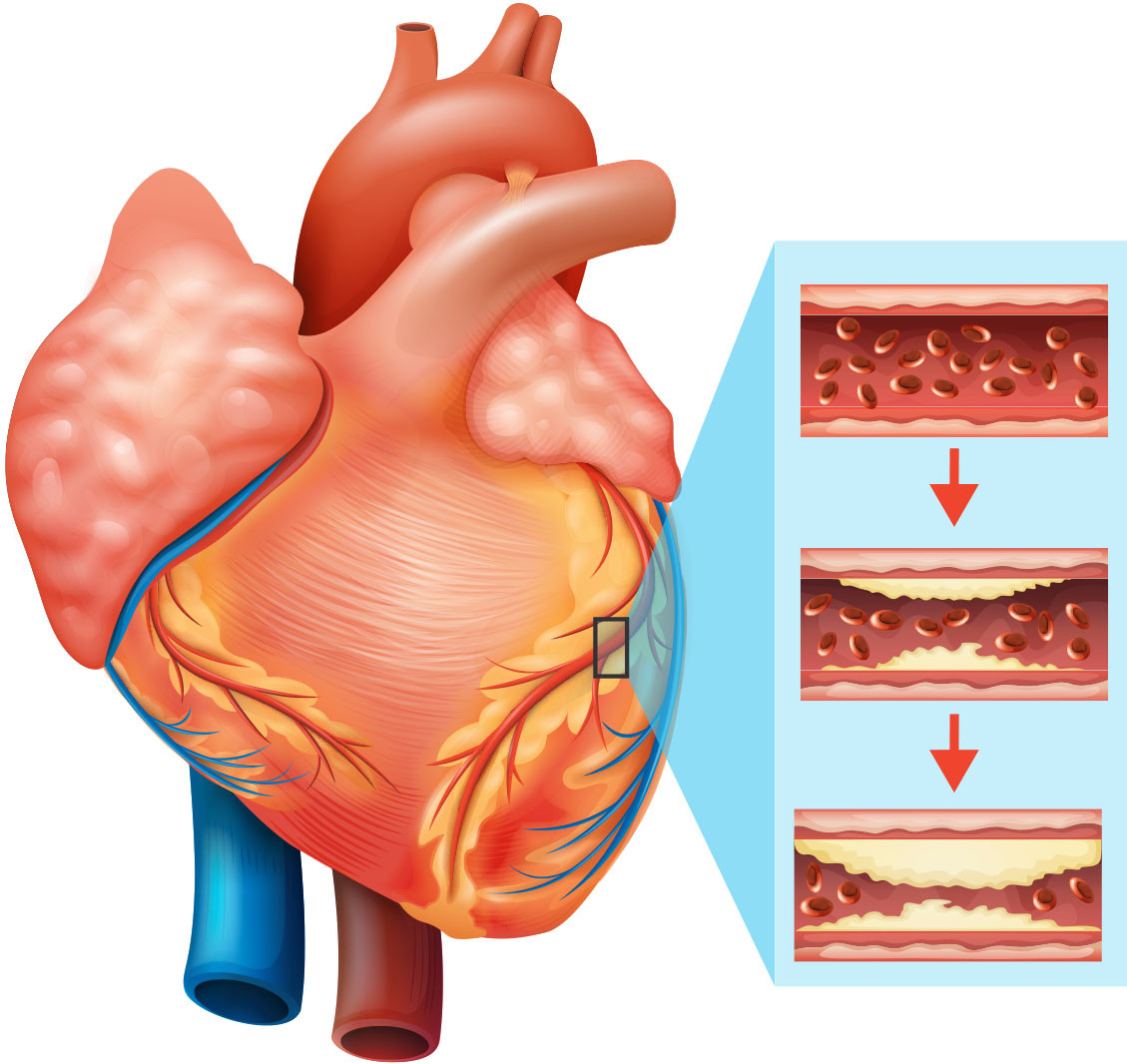 Is Heart Disease A Disability Uk